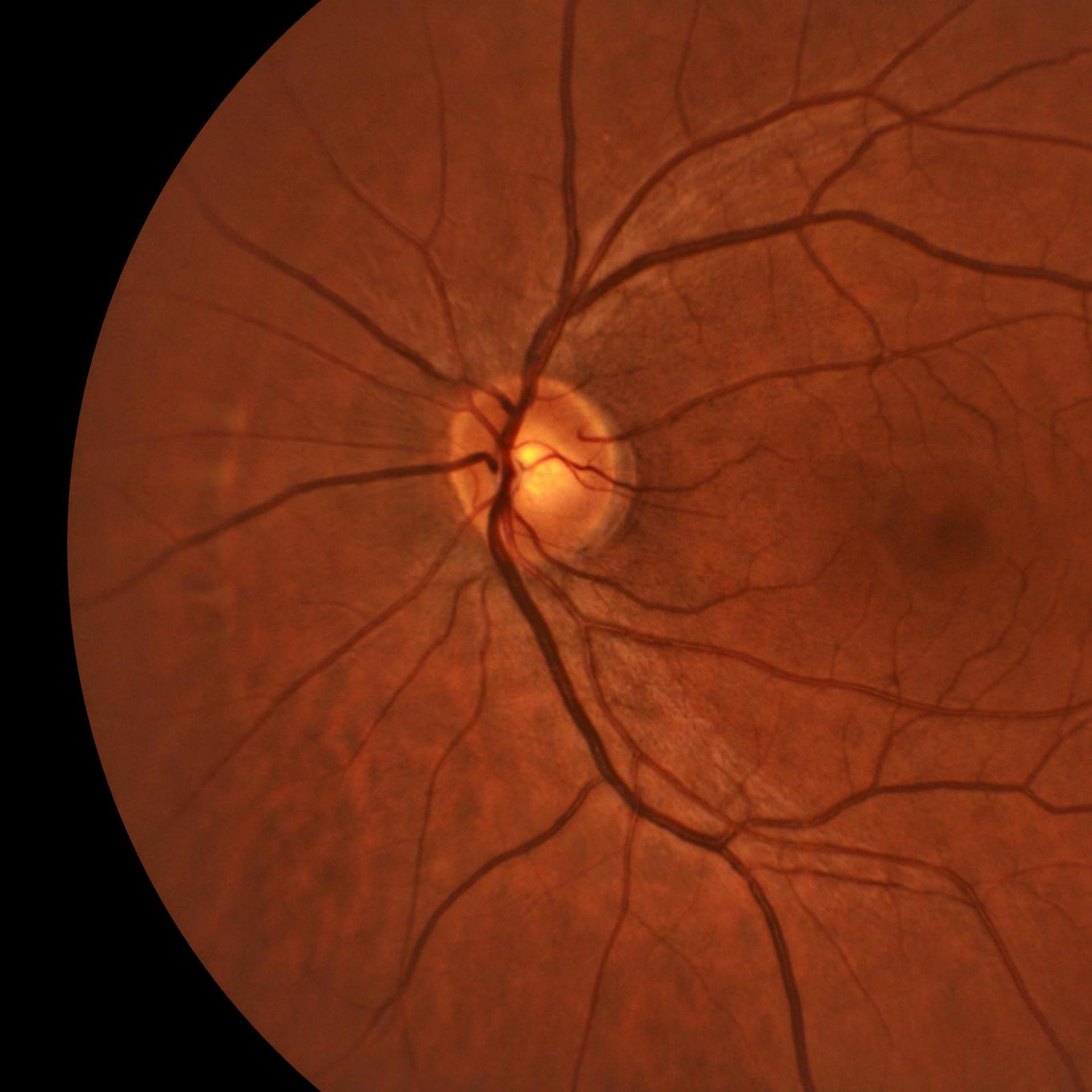 Silmän takaosan analyysi.