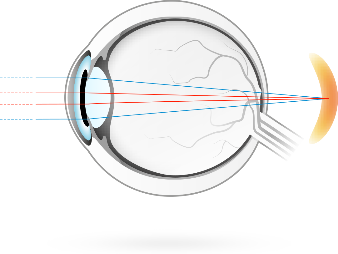 Kaukonäköisyys – sairaus, jossa kuvat tarkentuvat verkkokalvon takana, jolloin silmien on vaikeampi tarkentaa lähellä oleviin kohteisiin