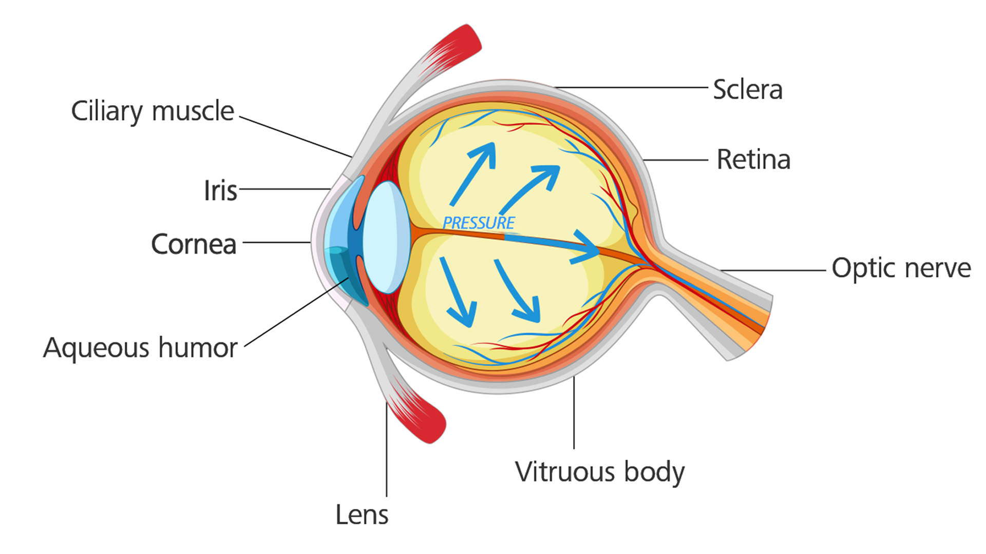Silmä, jossa on glaukooma: Silmänpaine nousee ja aiheuttaa vauriota näköhermolle.