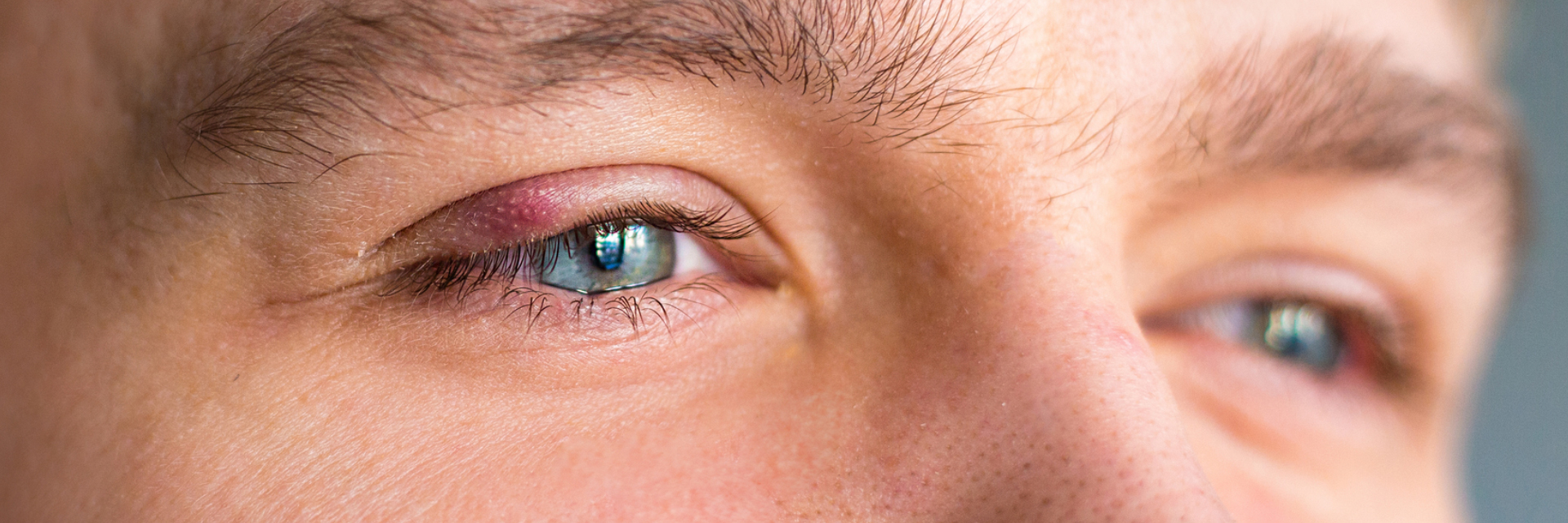Silmäluomen tulehdus (blefariitti)