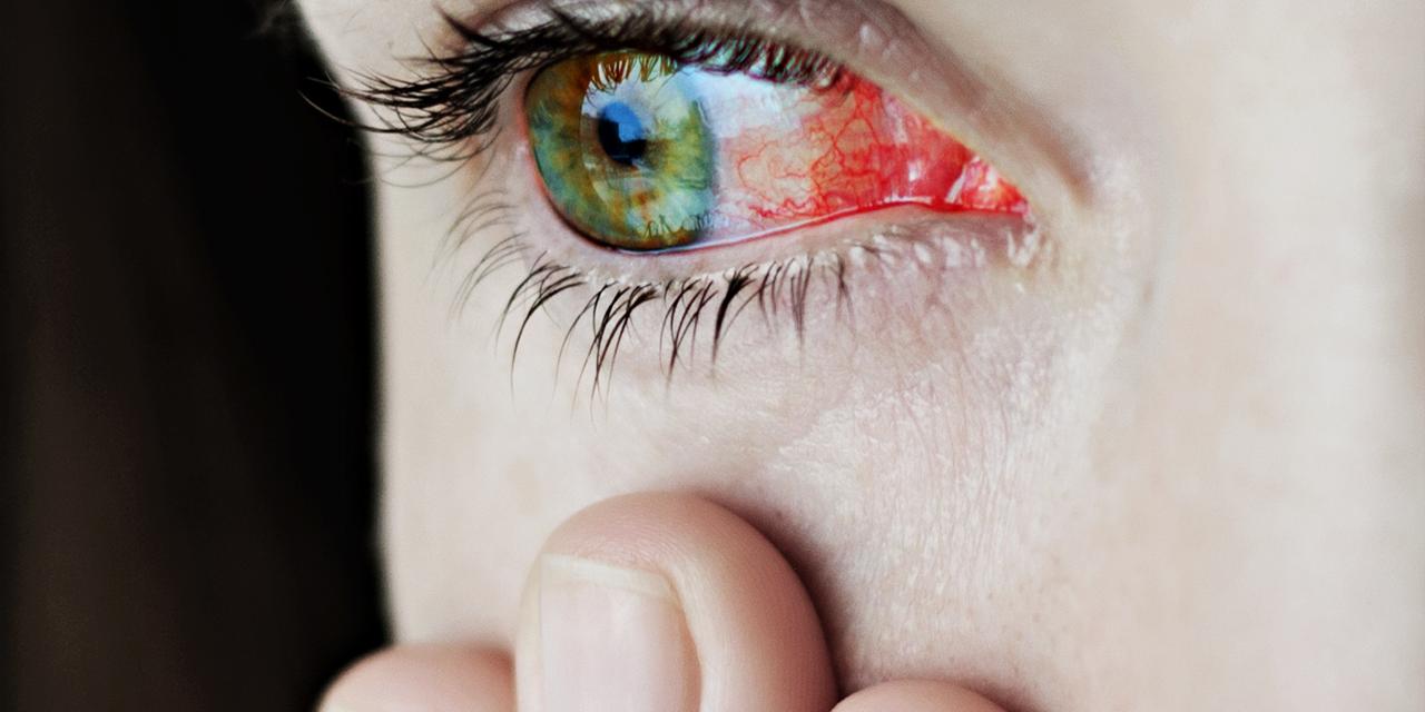 Lähikuva ärtyneistä tai tulehtuneista verestävän punaisista silmistä – uveiitti
