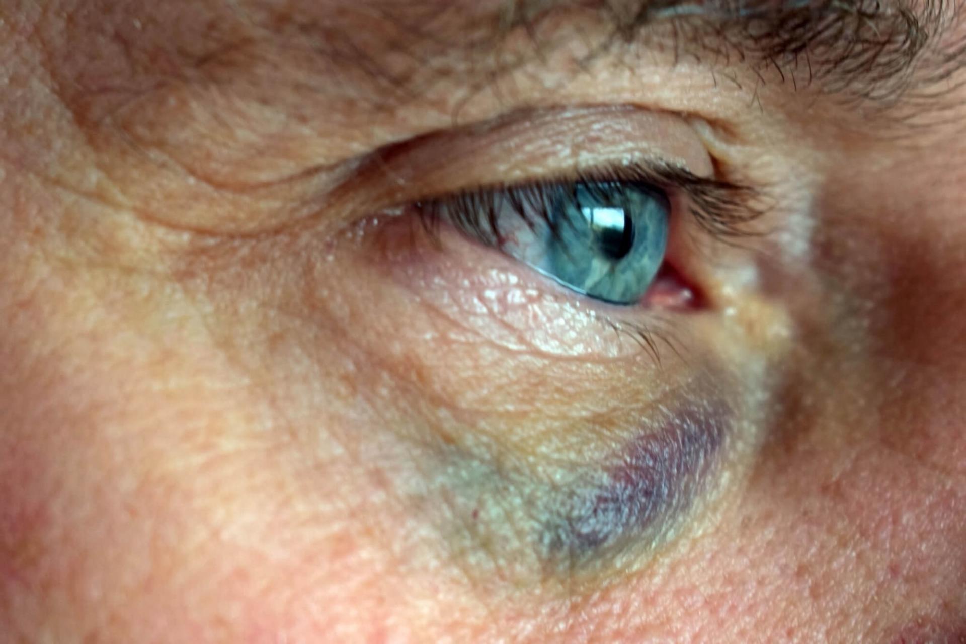 Tylpän iskun seurauksena silmän verisuonet voivat rikkoutua ja silmän valkoinen osa (valkuainen) näyttää punaiselta ja verestävältä.