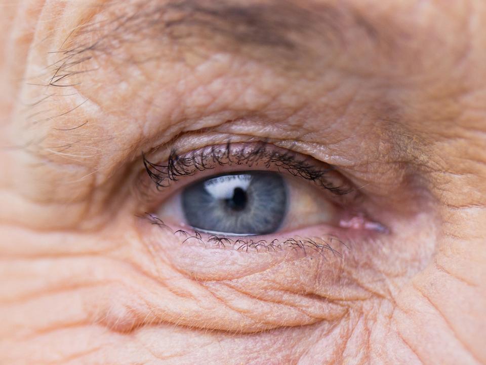 Kuvassa näkyy silmä, jonka ympärillä oleva iho kärsi auringonvalon aiheuttamasta vanhenemisesta.