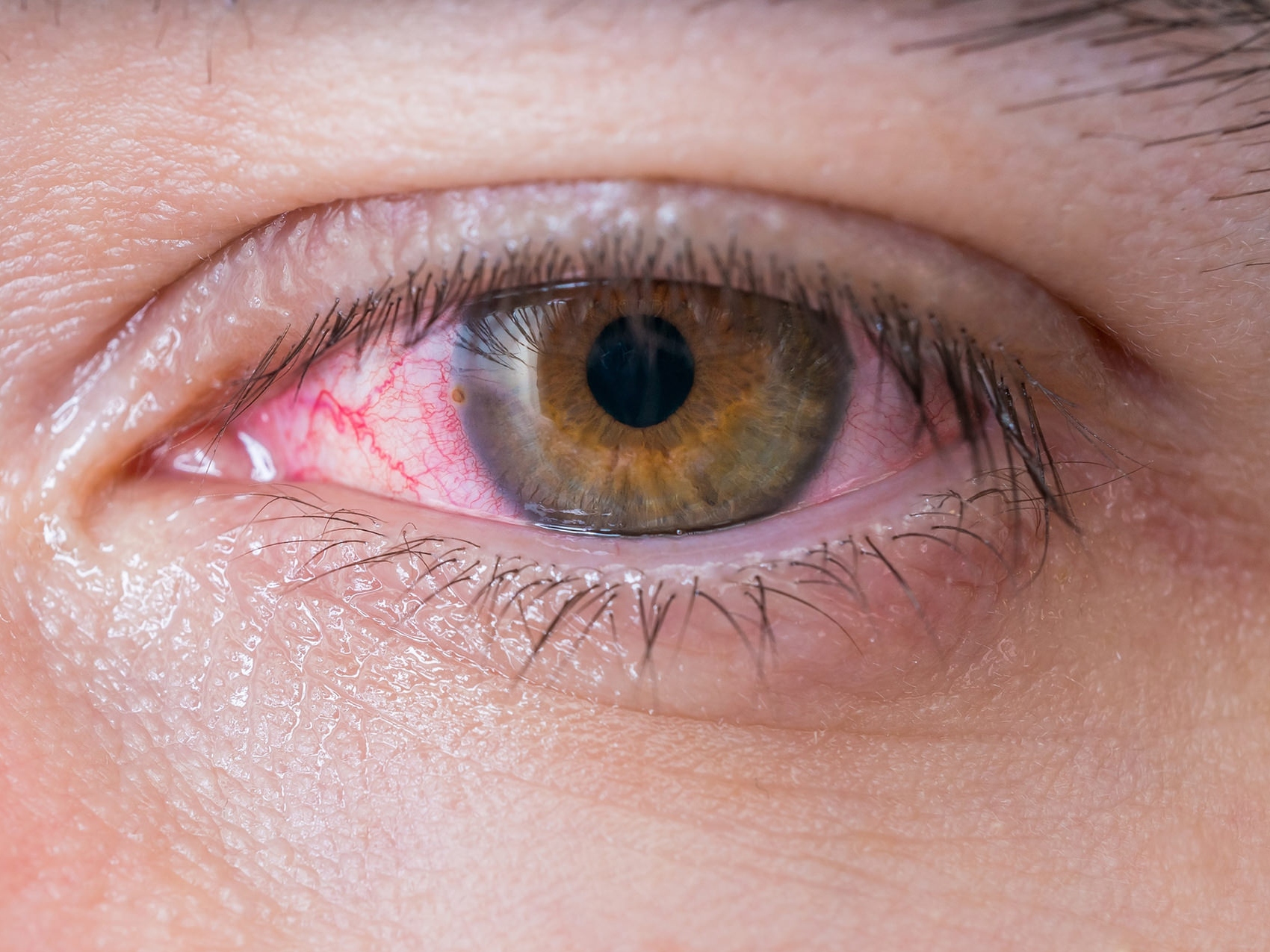 Kuvassa on lähikuva sairaasta silmästä, ja se kuvaa mahdollisten silmien vaarojen ilmenemistä. 